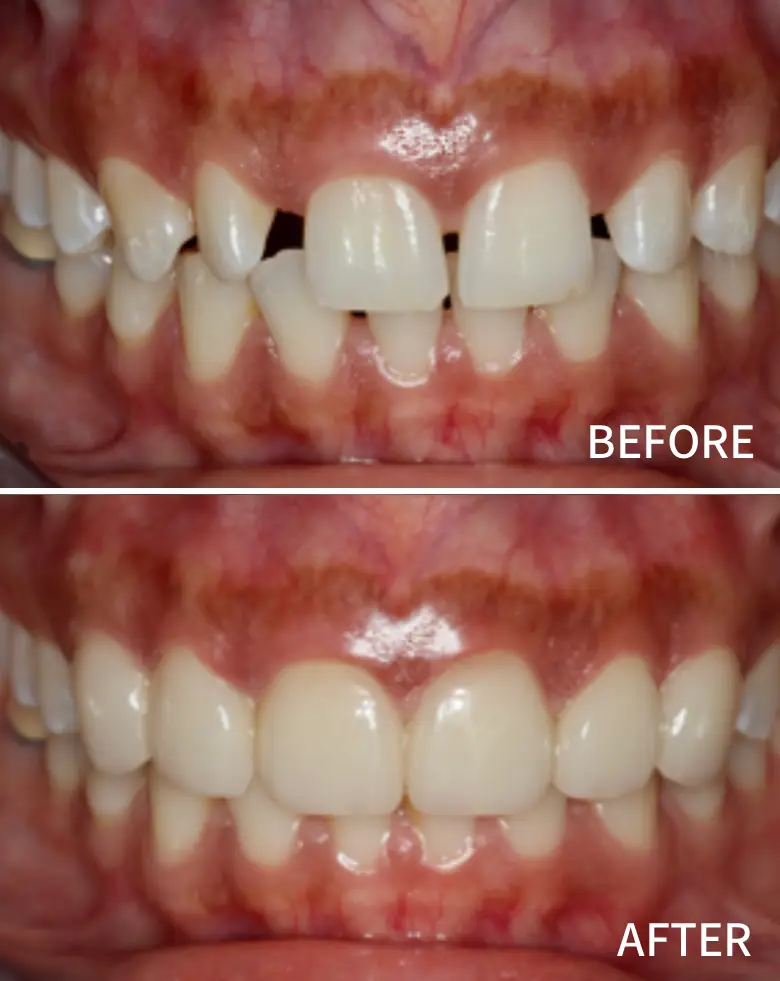 Before-and-after image of dental transformation highlighting diastema closure, anterior tooth restoration, and improved alignment, showcasing successful full mouth rehabilitation at NuSmile Implant Studio.