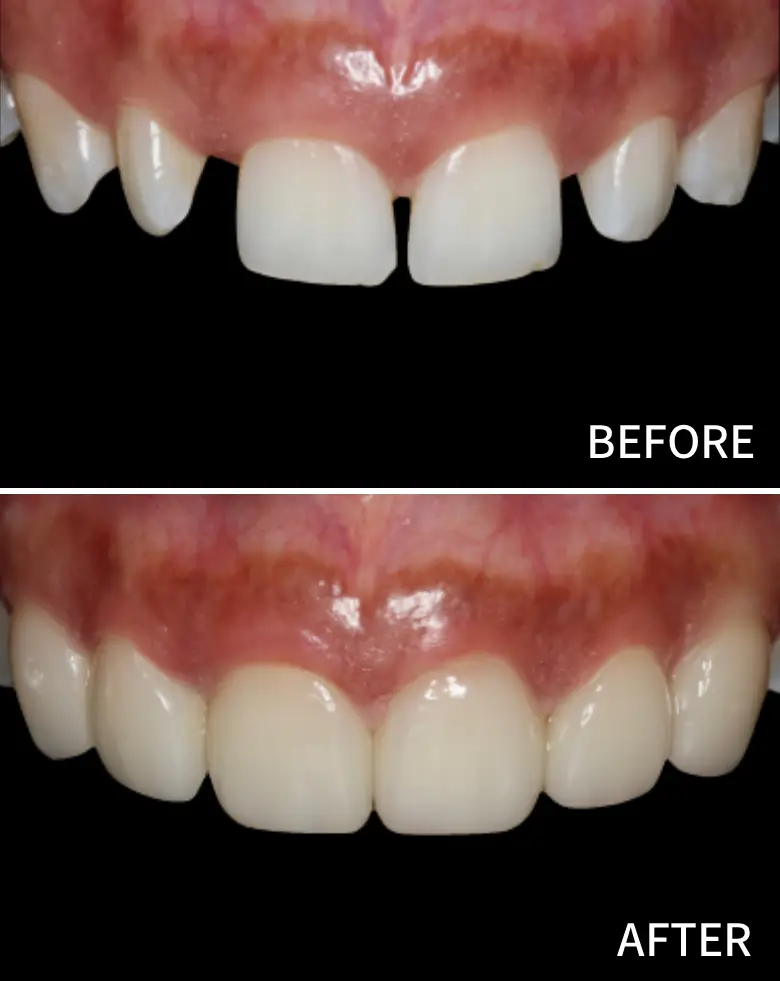 Before-and-after image of a smile transformation showcasing correction of diastema and anterior tooth alignment, highlighting cosmetic dental restoration results.