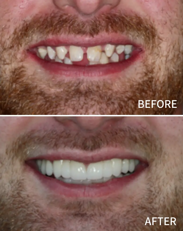 Before-and-after image of a male patient showcasing significant smile transformation, highlighting diastema closure and improved anterior tooth aesthetics after dental rehabilitation.