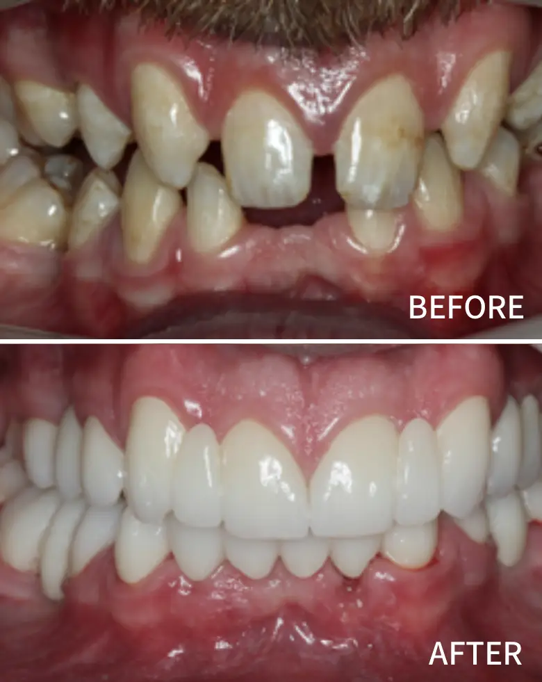 Before-and-after image of dental transformation showing significant improvement in smile aesthetics, addressing diastema and tooth restoration.