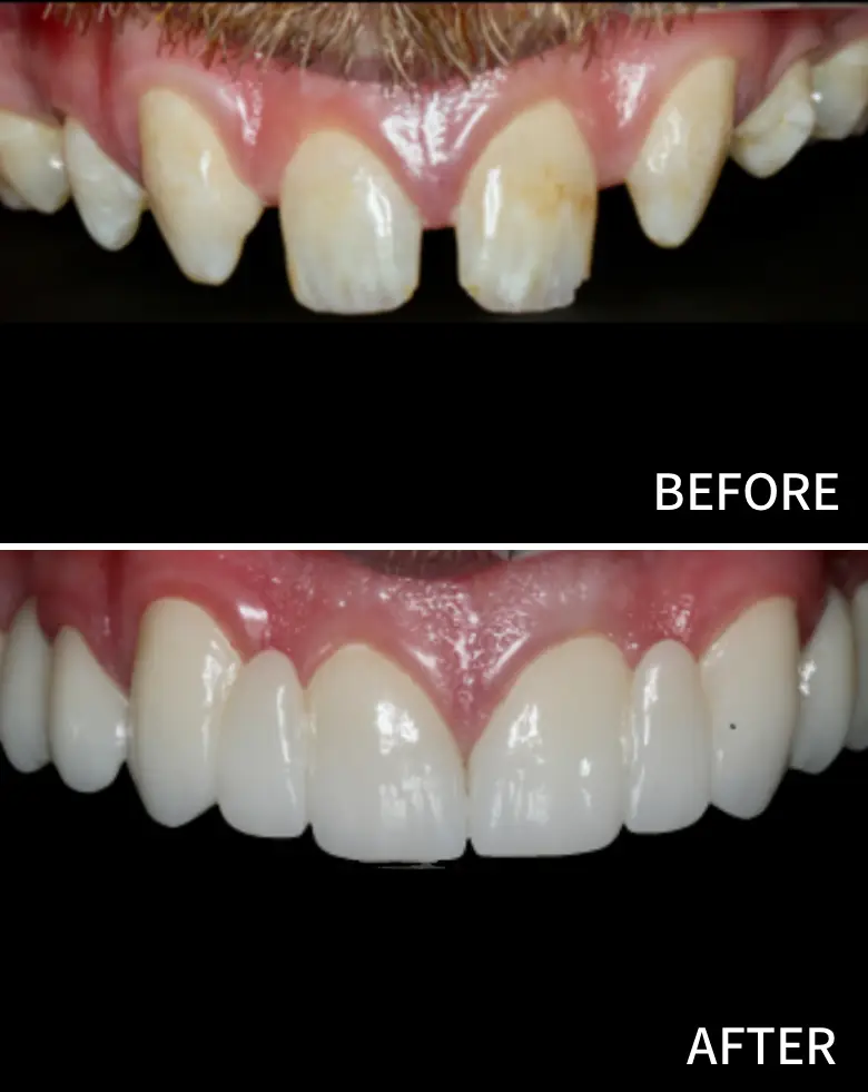 Before-and-after image of a dental transformation showcasing a smile makeover, highlighting diastema closure and restoration of anterior teeth for improved aesthetics.