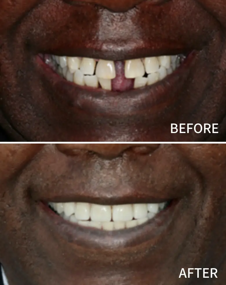 Before-and-after images of a smile transformation showcasing diastema closure and improved anterior teeth aesthetics, highlighting the effectiveness of cosmetic dentistry at NuSmile Implant Studio.