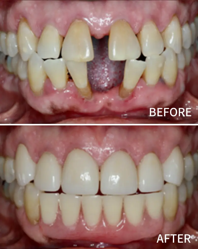 Before-and-after dental transformation showcasing diastema correction and anterior tooth restoration, highlighting improved smile aesthetics and alignment.