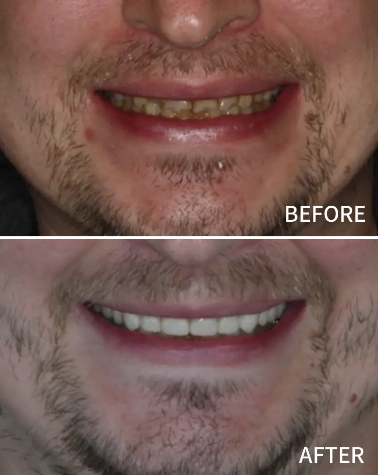 Before-and-after image showcasing a dental transformation, highlighting significant improvements in tooth color and alignment, addressing issues of tooth wear and anterior tooth loss.