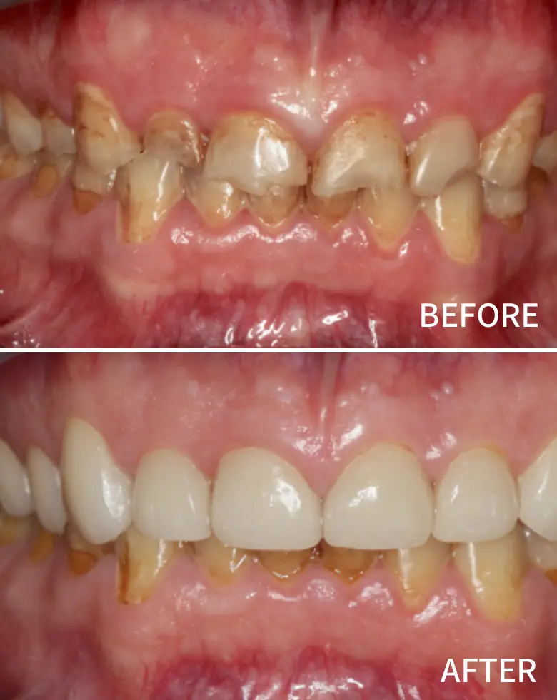 Before-and-after images of dental restoration showing significant improvement in tooth appearance, addressing issues of generalized tooth wear and anterior tooth loss.