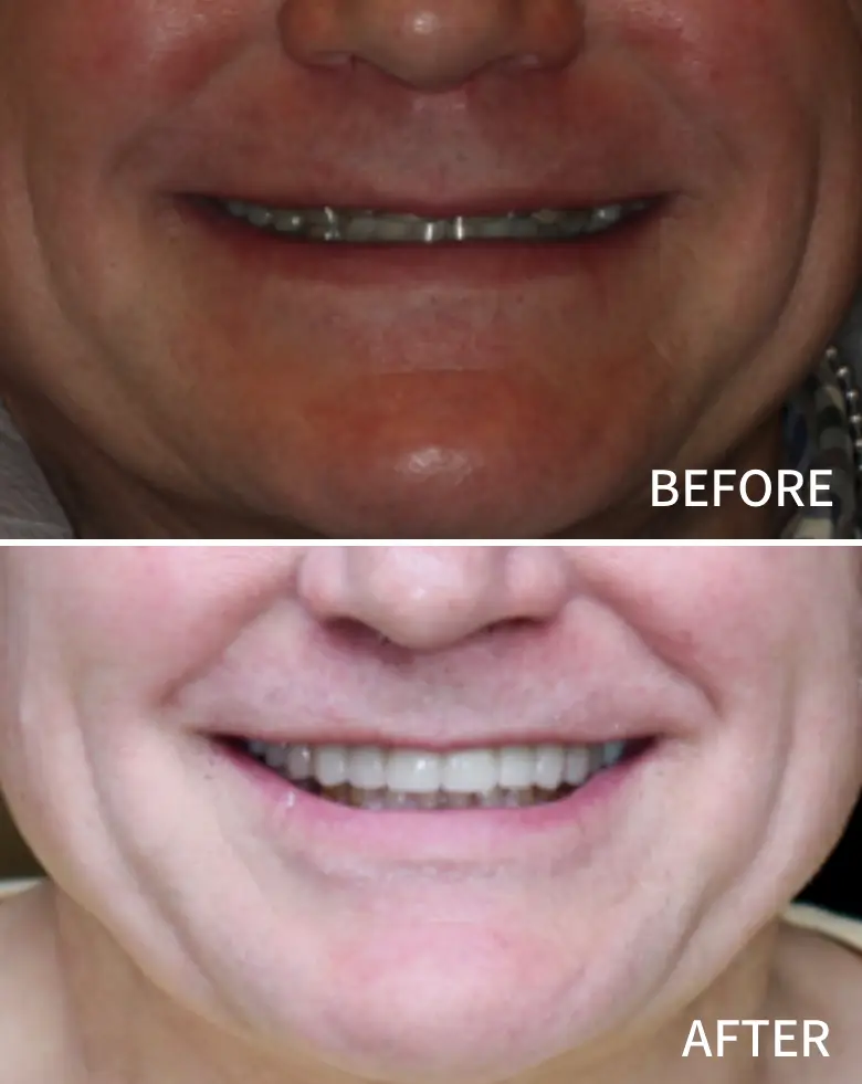 Before-and-after images showcasing dental transformation, highlighting smile improvement, tooth restoration, and enhanced aesthetics.