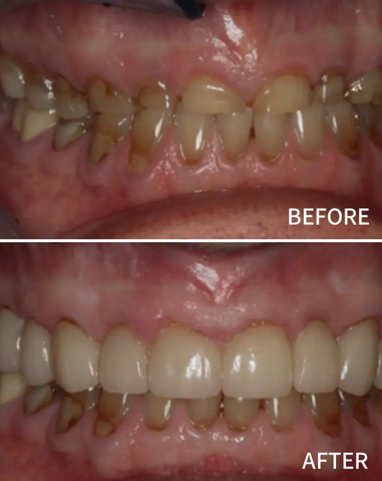 Before-and-after image showcasing significant dental restoration, highlighting multiple failing restorations, generalized tooth wear, and improved aesthetics in smile transformation.